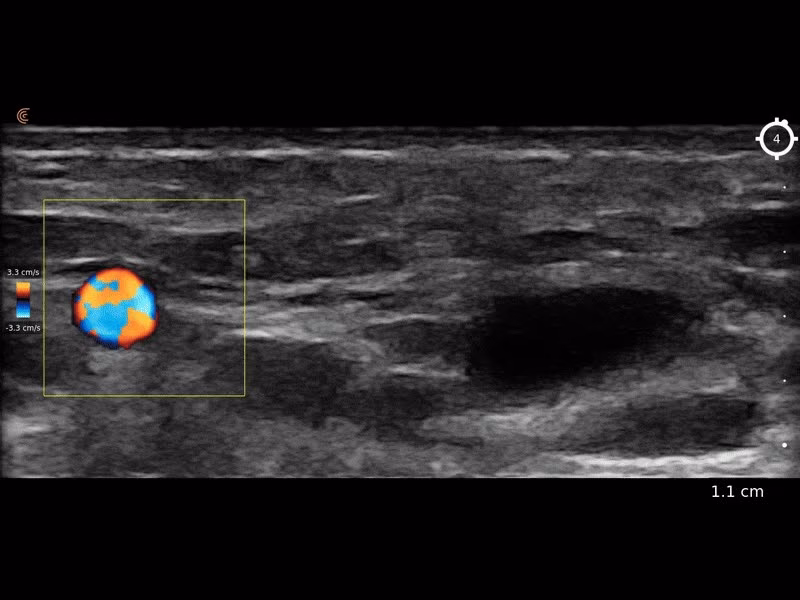 Clarius ultrasound Doppler view (sample image)